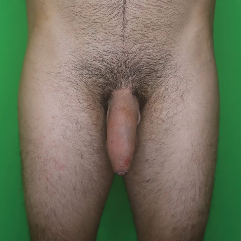 Enhancement_after_13